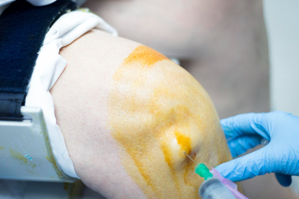 Viscosuplementación